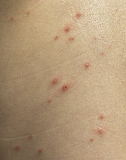rash