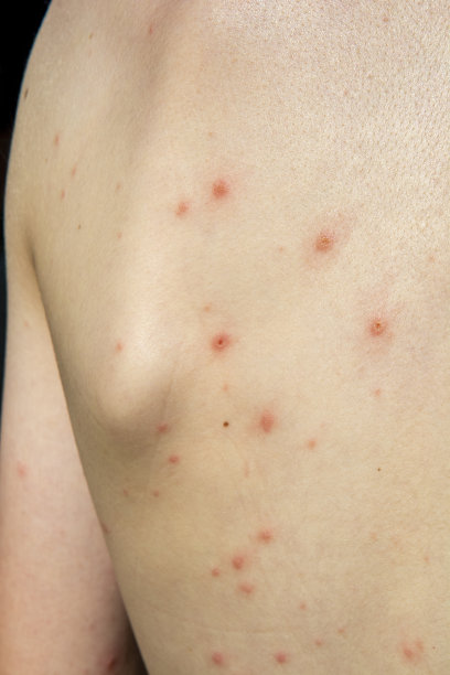 rash