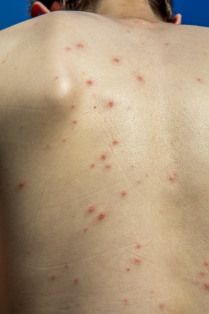 rash