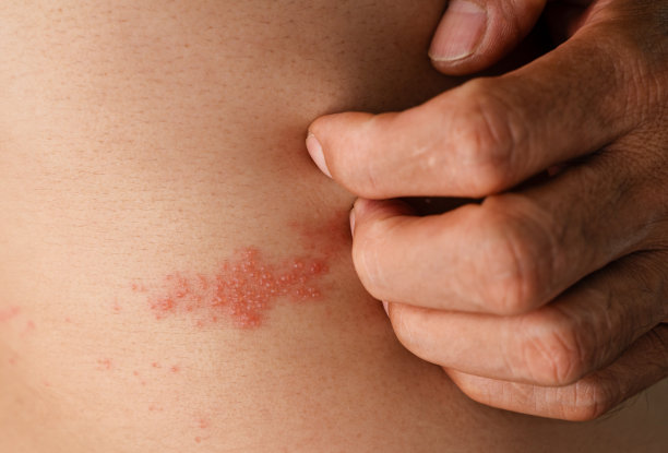 rash