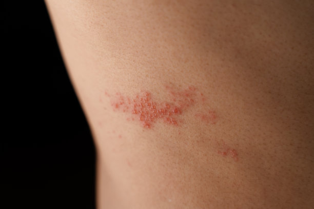 rash