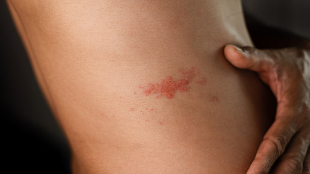 rash