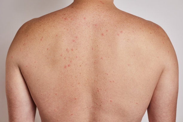 rash
