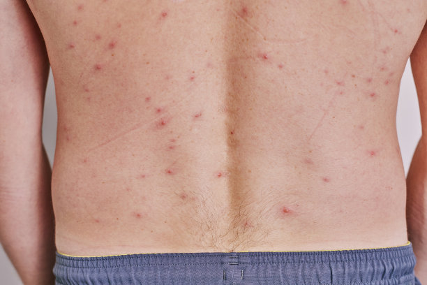 rash