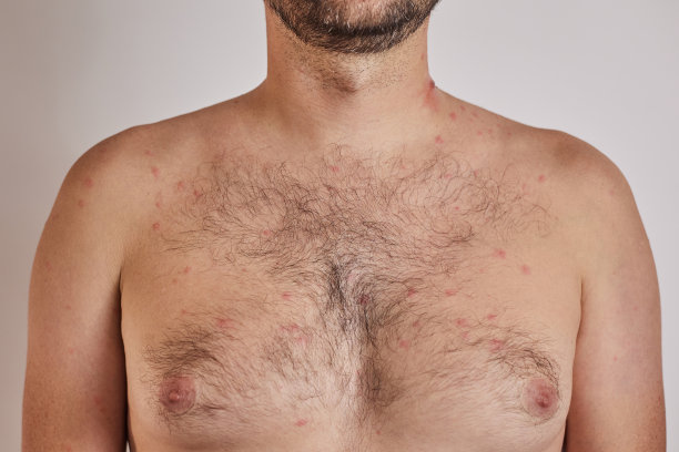 rash