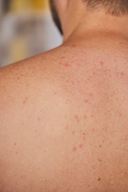 rash