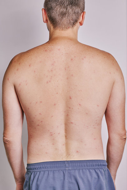 rash