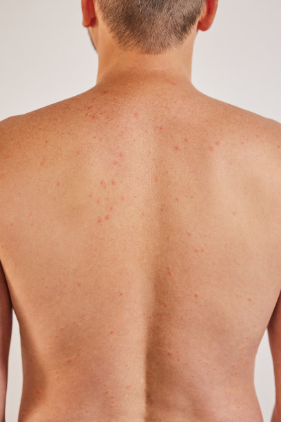 rash