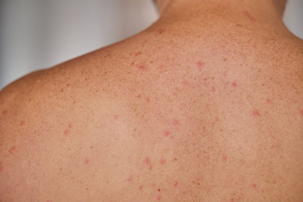 rash