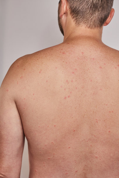 rash