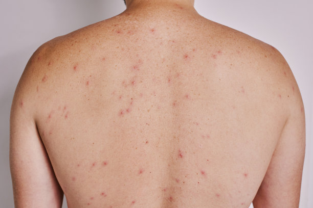 rash