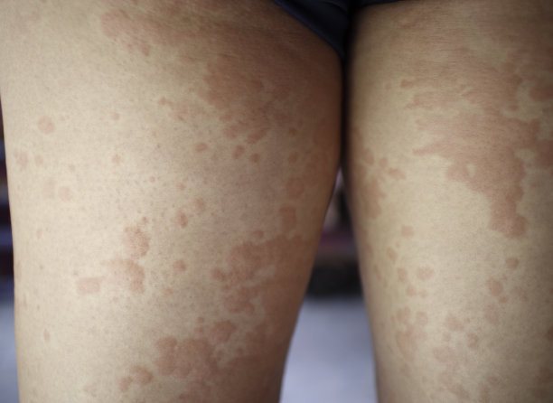 rash