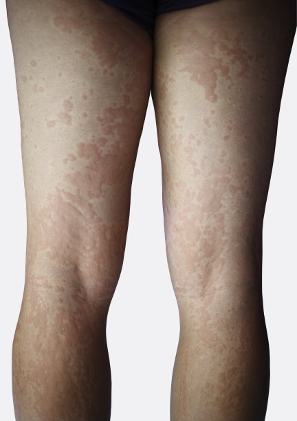 rash