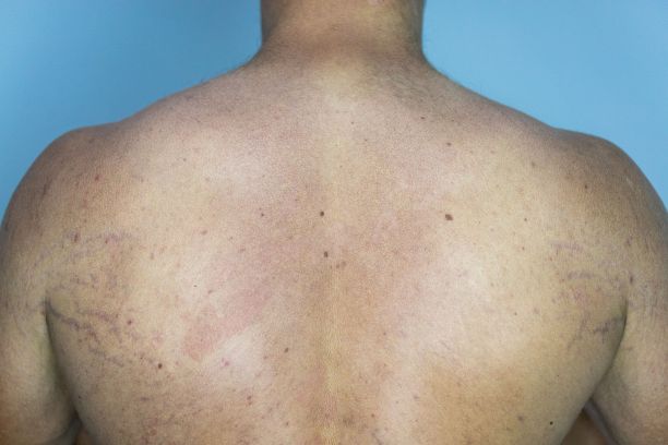 rash