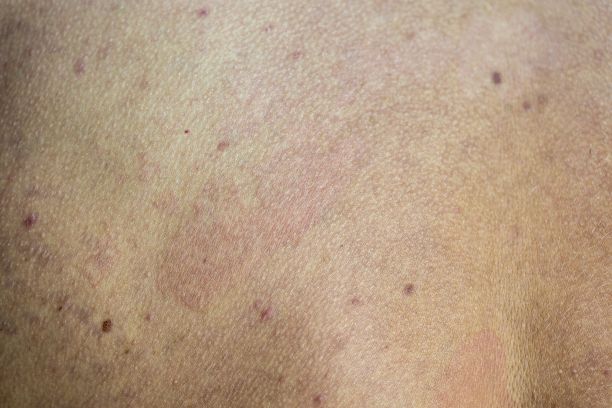 rash