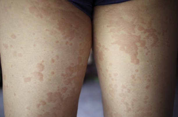 rash