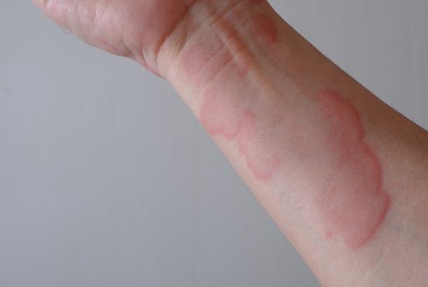 rash