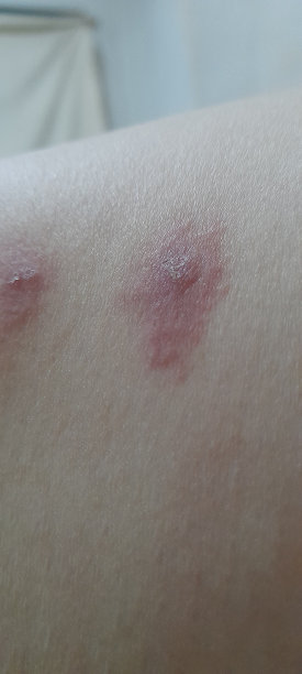 rash