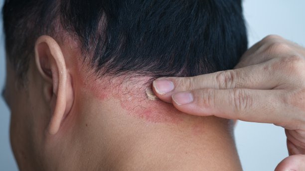 rash