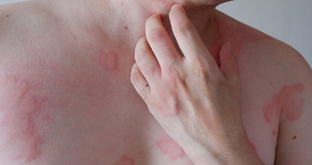 rash