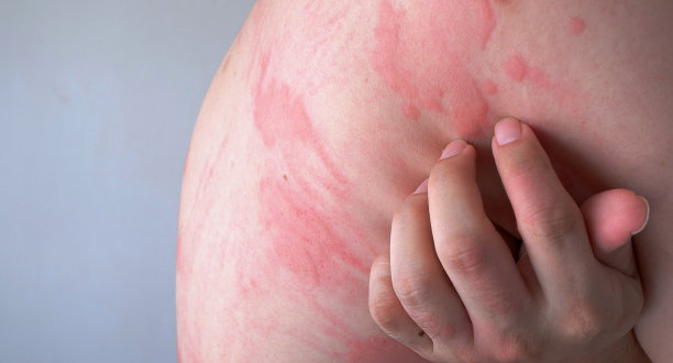 rash