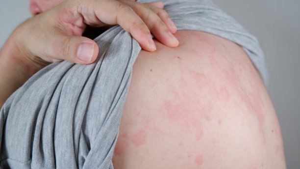 rash