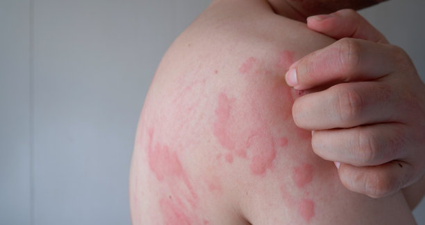 rash