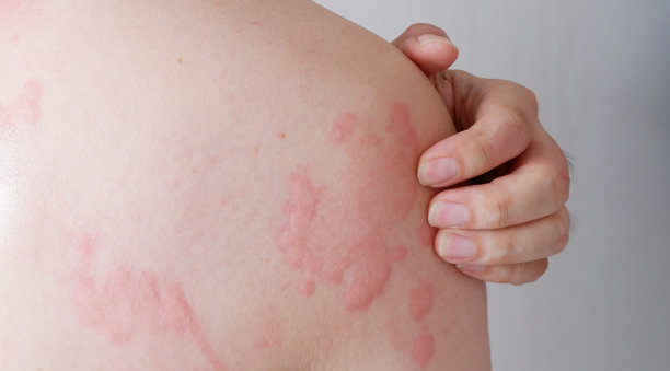 rash