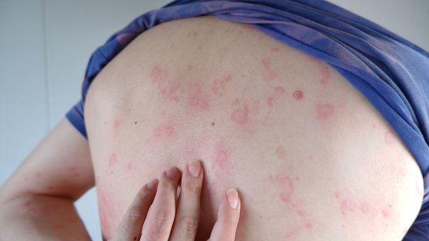 rash