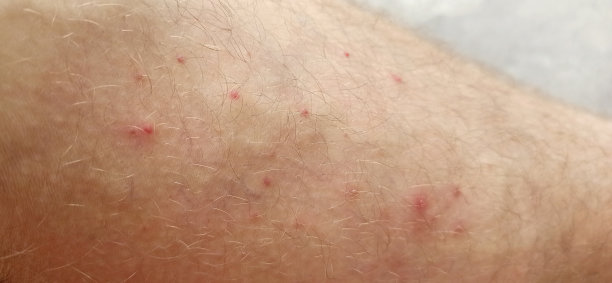 rash