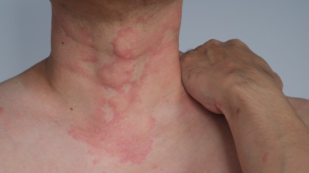 rash