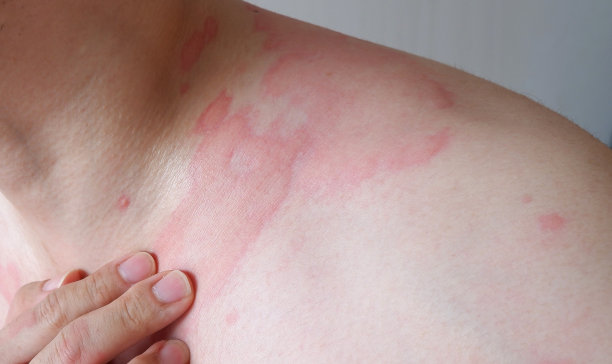 rash