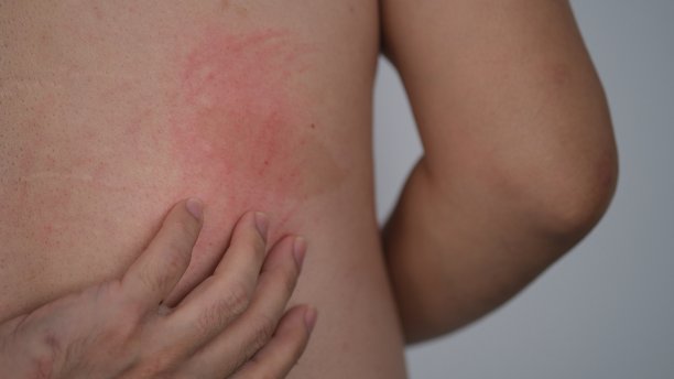 rash