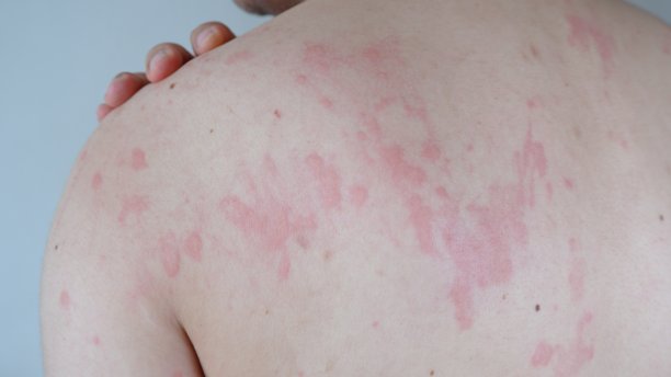 rash