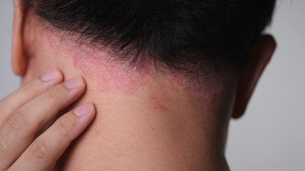 rash