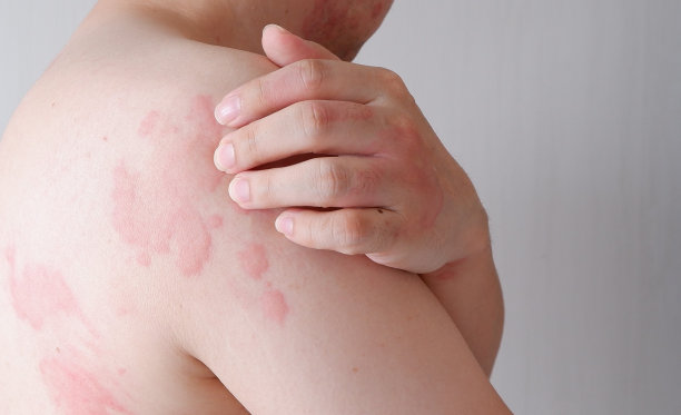 rash