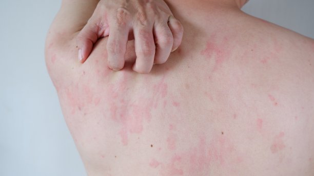 rash