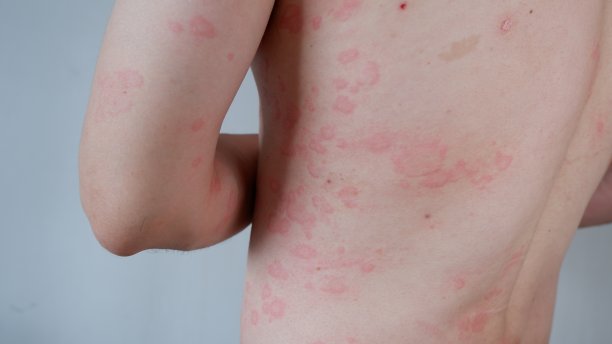 rash