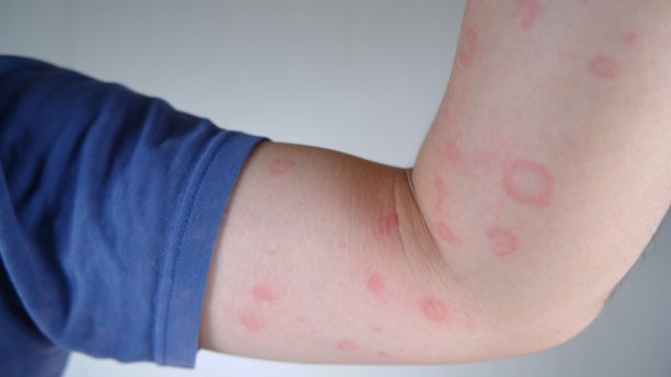 rash