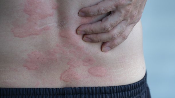 rash