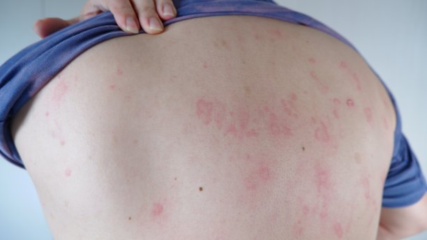 rash