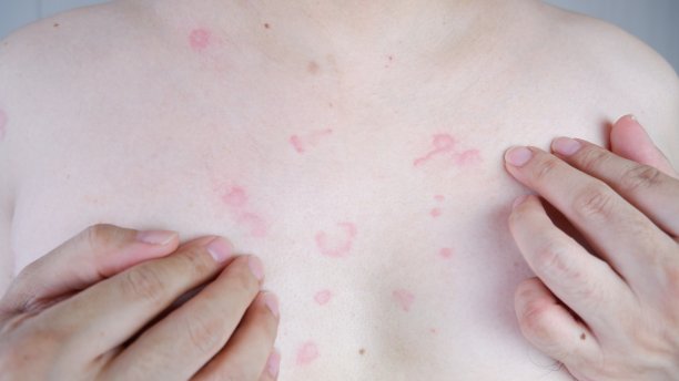 rash