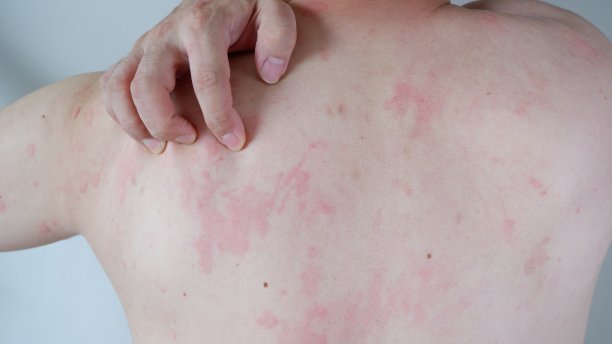 rash