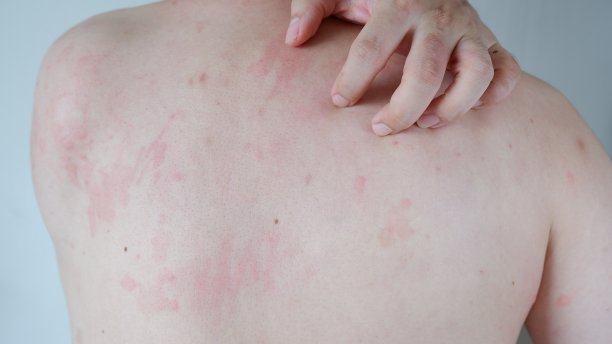 rash