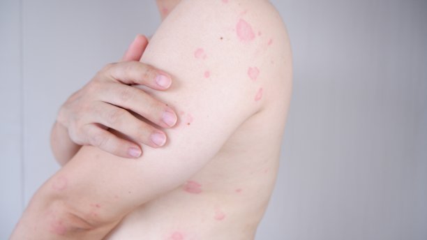 rash