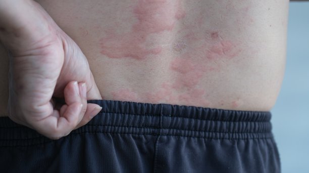rash