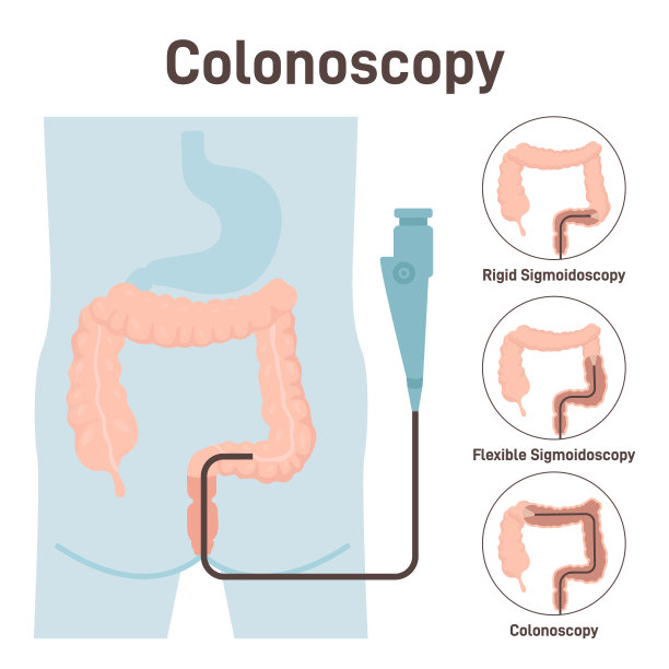 肠癌检测