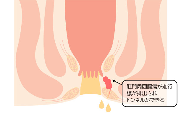 地道肠