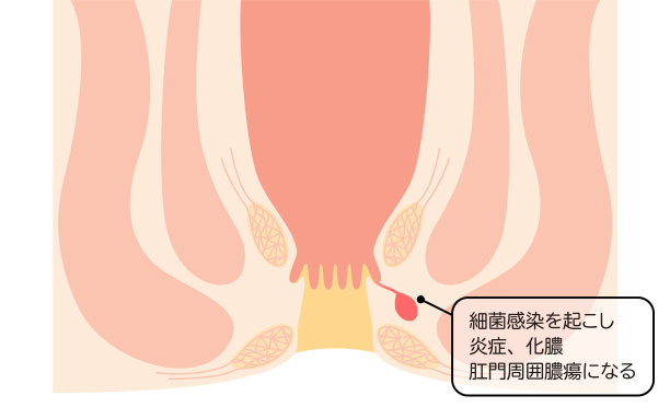 地道肠