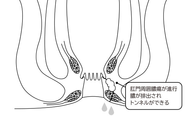地道肠